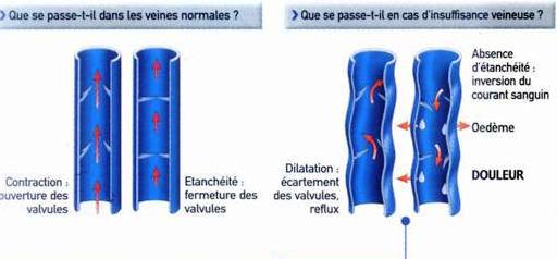 insuff veineuse