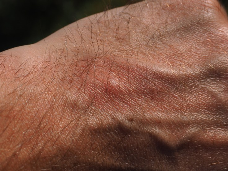 mosquito-bite-2117421_1280